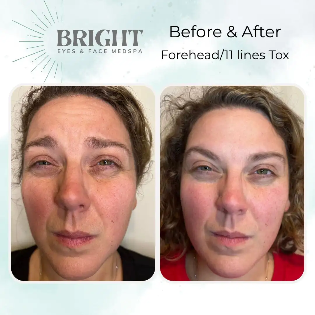 Before & After a-Bright-Eyes-and-Face-Med-Spa-Hazleton-PA