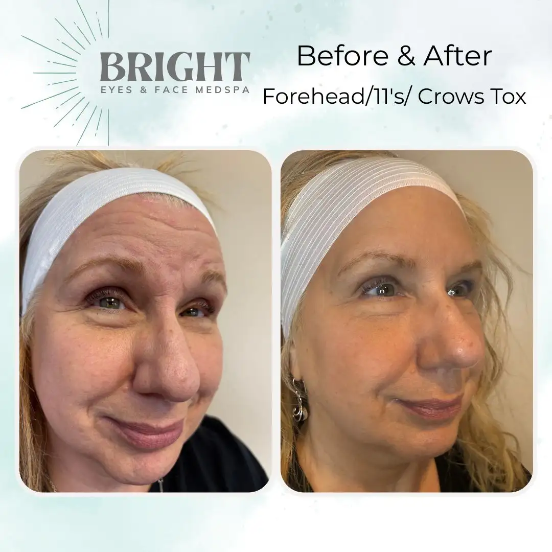 Before & After b-Bright-Eyes-and-Face-Med-Spa-Hazleton-PA
