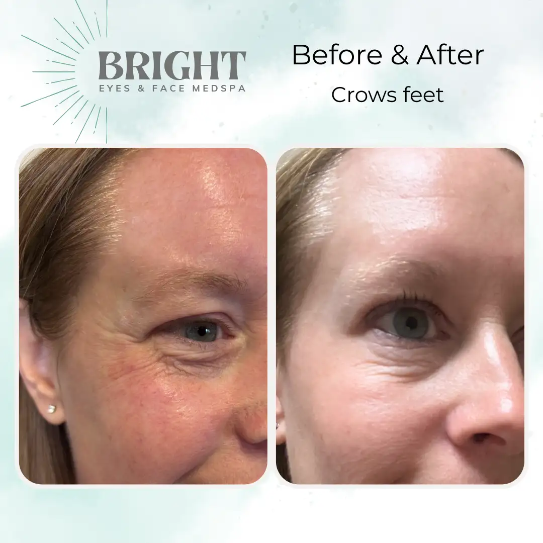 Before & After c-Bright-Eyes-and-Face-Med-Spa-Hazleton-PA