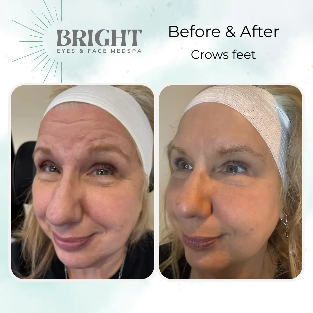 Before & After d-Bright-Eyes-and-Face-Med-Spa-Hazleton-PA