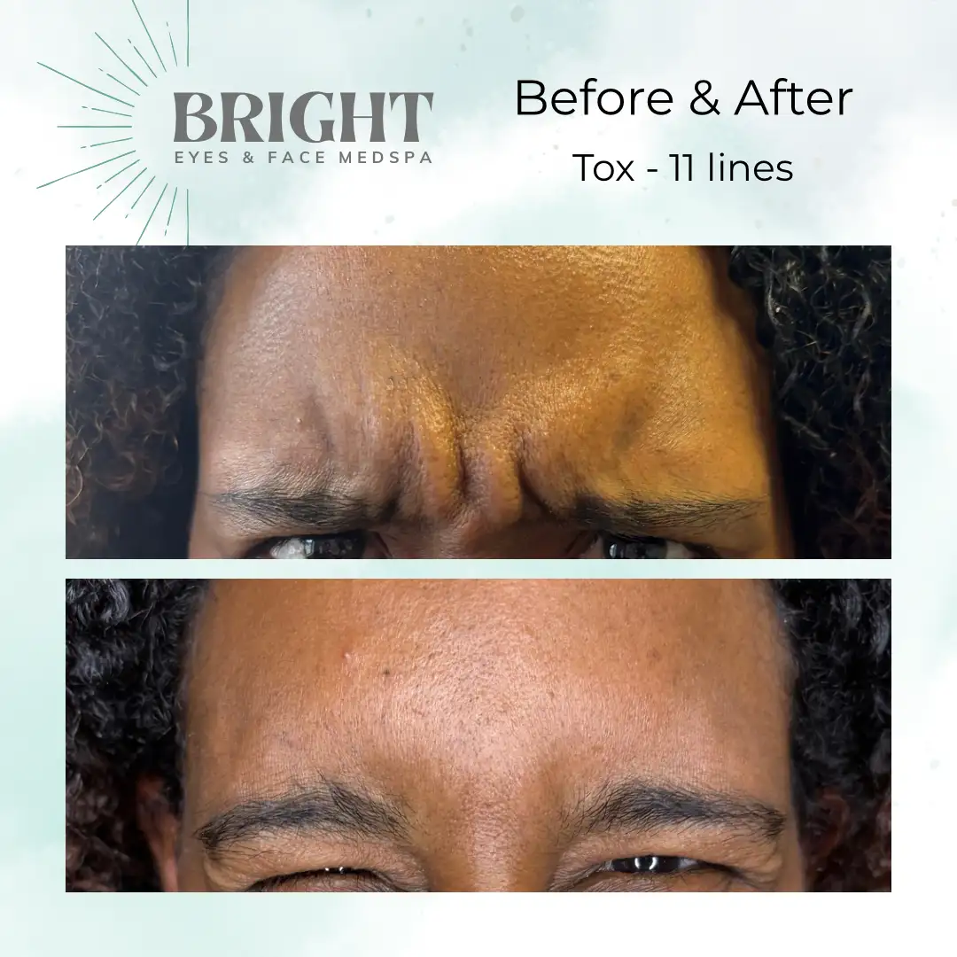 Before & After e-Bright-Eyes-and-Face-Med-Spa-Hazleton-PA