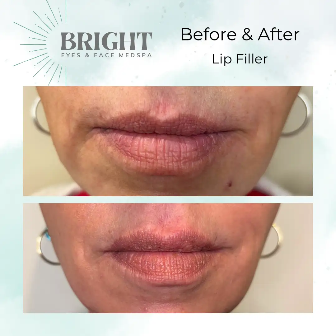 Before & After f-Bright-Eyes-and-Face-Med-Spa-Hazleton-PA