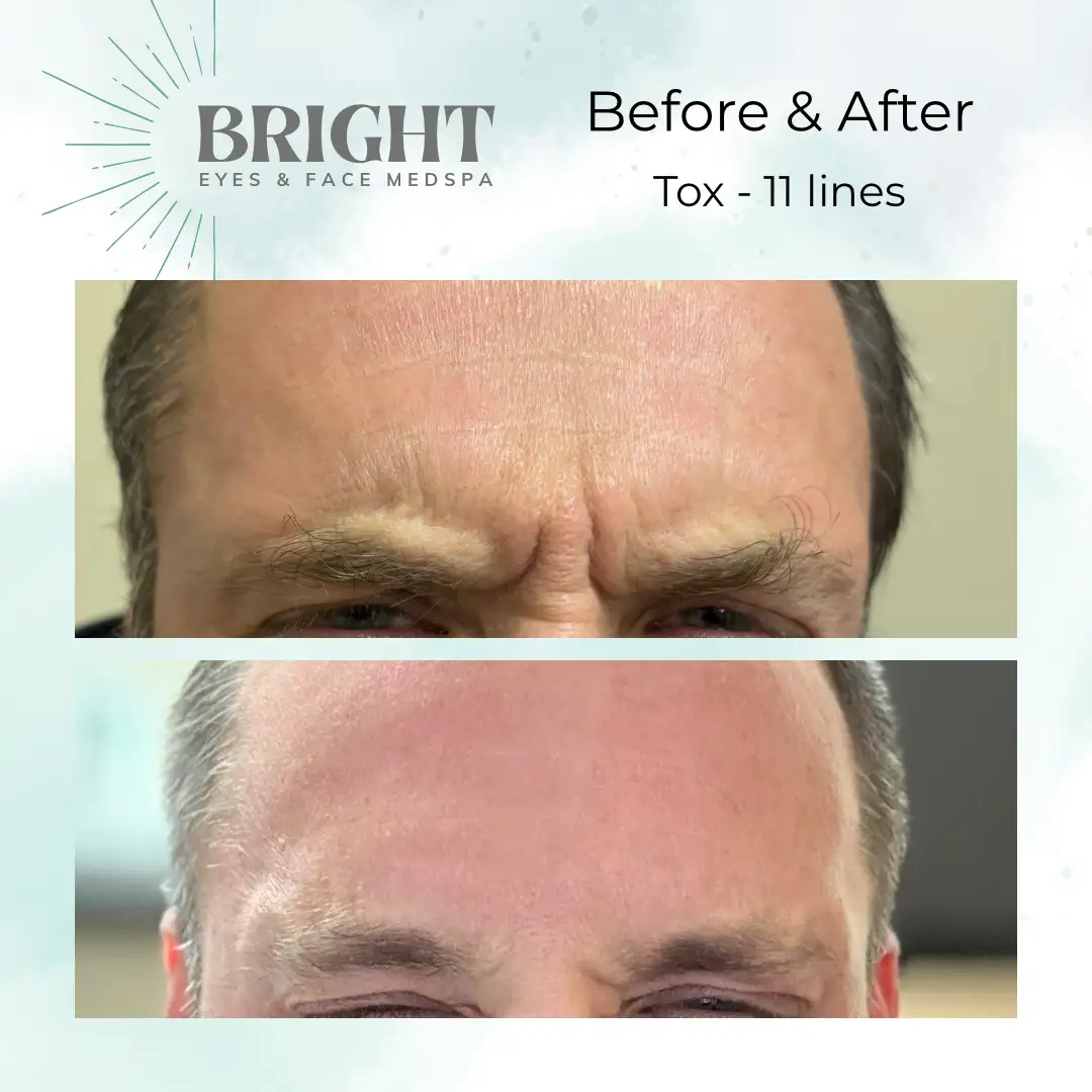 Before & After g-Bright-Eyes-and-Face-Med-Spa-Hazleton-PA