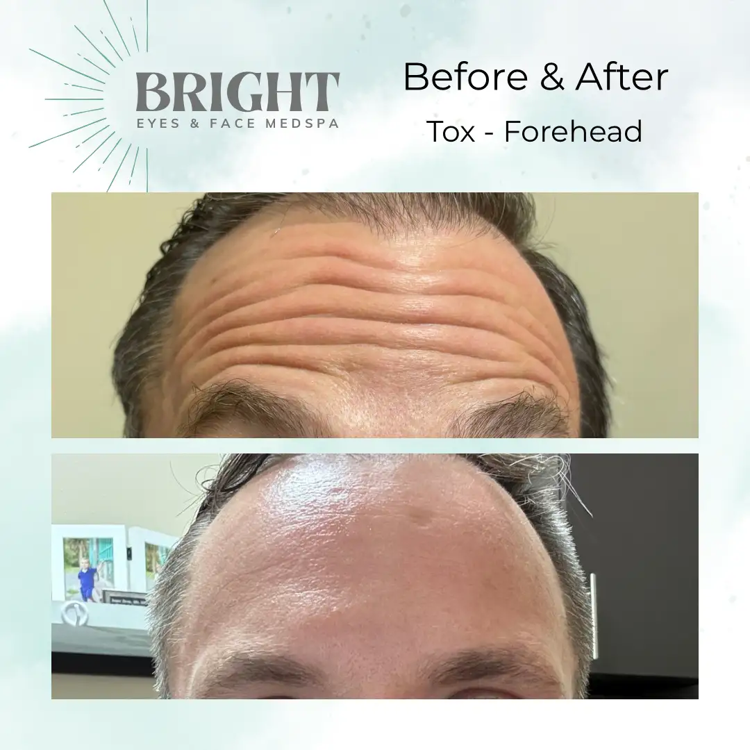 Before & After h-Bright-Eyes-and-Face-Med-Spa-Hazleton-PA