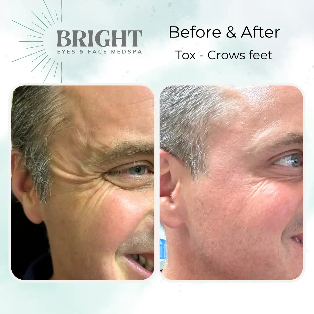 Before & After i-Bright-Eyes-and-Face-Med-Spa-Hazleton-PA