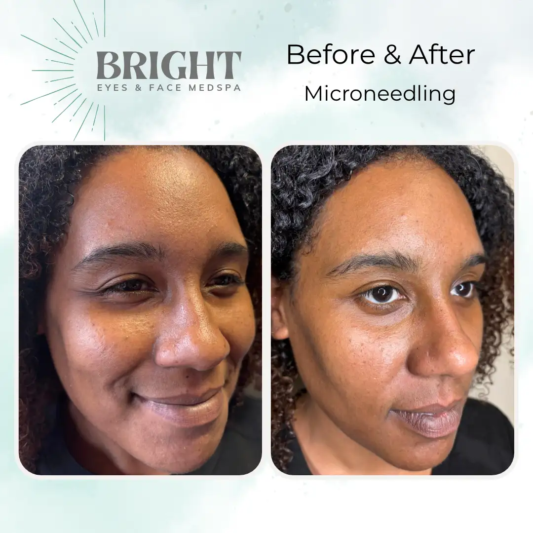 Before & After j-Bright-Eyes-and-Face-Med-Spa-Hazleton-PA