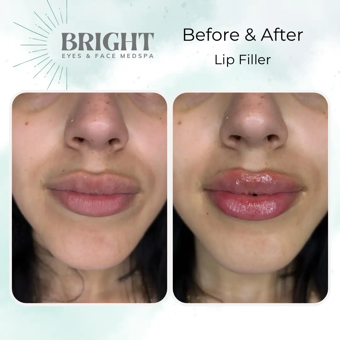 Before & After k-Bright-Eyes-and-Face-Med-Spa-Hazleton-PA