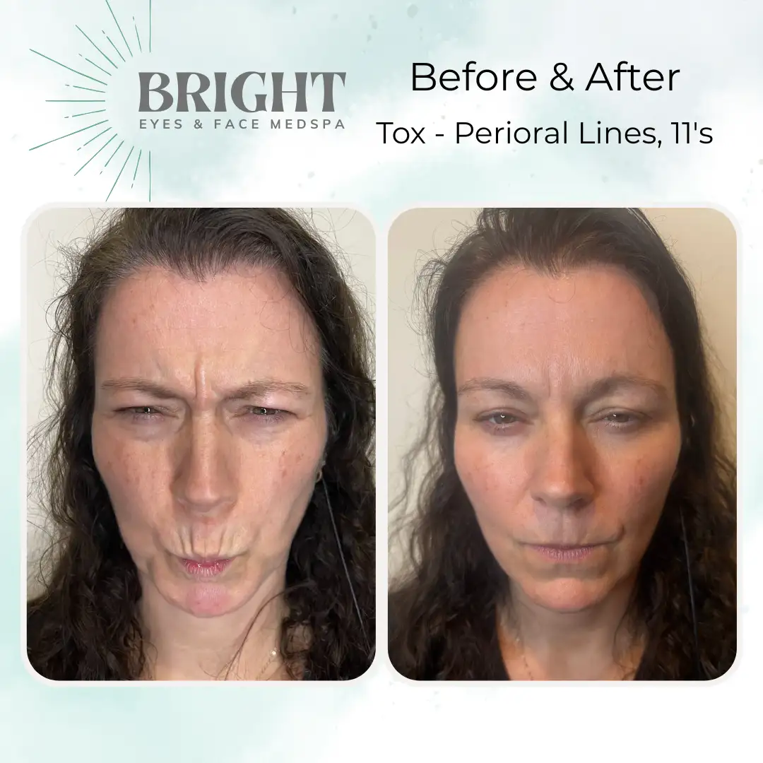 Before & After m-Bright-Eyes-and-Face-Med-Spa-Hazleton-PA