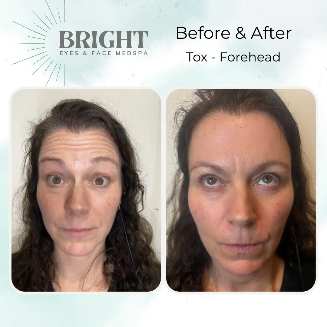 Before & After n-Bright-Eyes-and-Face-Med-Spa-Hazleton-PA