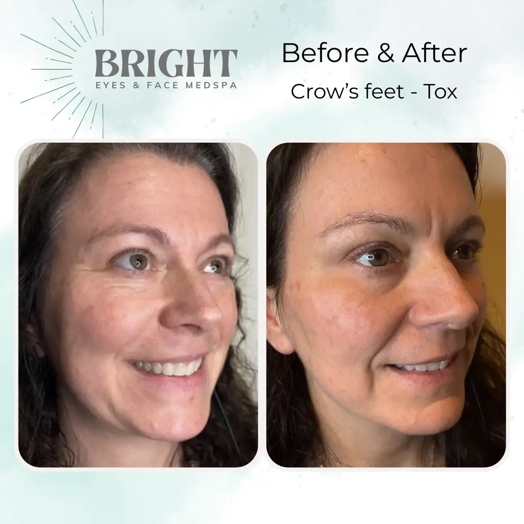 Before & After o-Bright-Eyes-and-Face-Med-Spa-Hazleton-PA