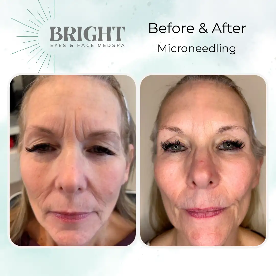 Before & After p-Bright-Eyes-and-Face-Med-Spa-Hazleton-PA
