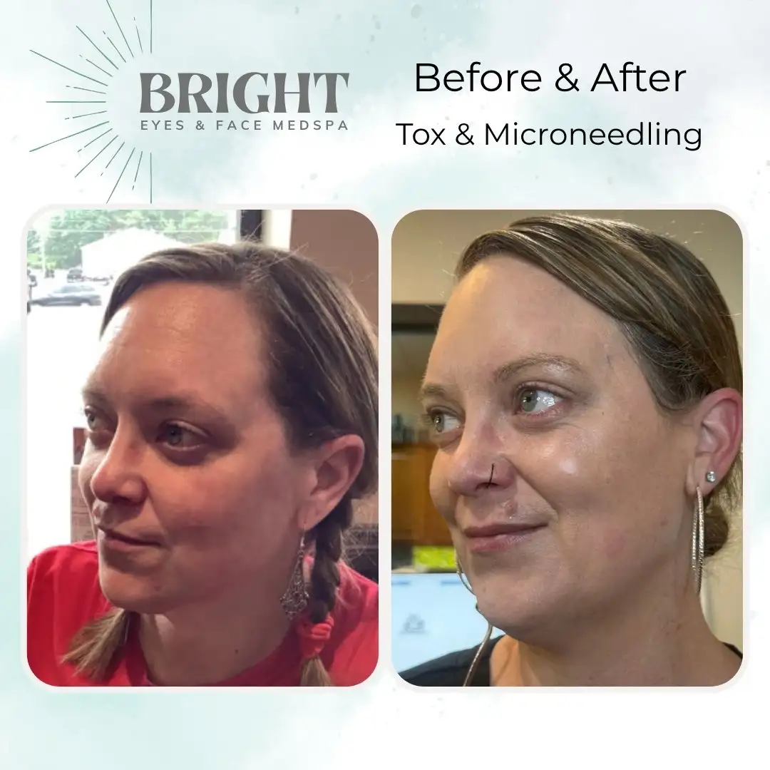 Before & After q-Bright-Eyes-and-Face-Med-Spa-Hazleton-PA